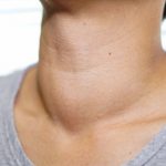 Conozca el riesgo de cáncer de tiroides
