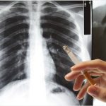 Fumadores con mayor riesgo de complicaciones al contraer Covid-19