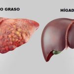 Qué debe tener en cuenta si tiene higado graso y contrae COVID-19